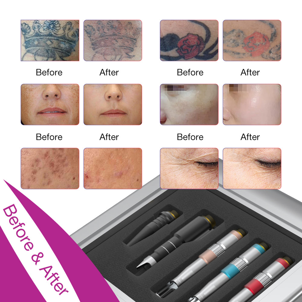 Laser Tattoo Removal Machine - Picosecond Laser Device with 532nm 755nm 1064nm
